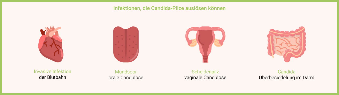 Candida Infektion, die Candida Pilz auslösen