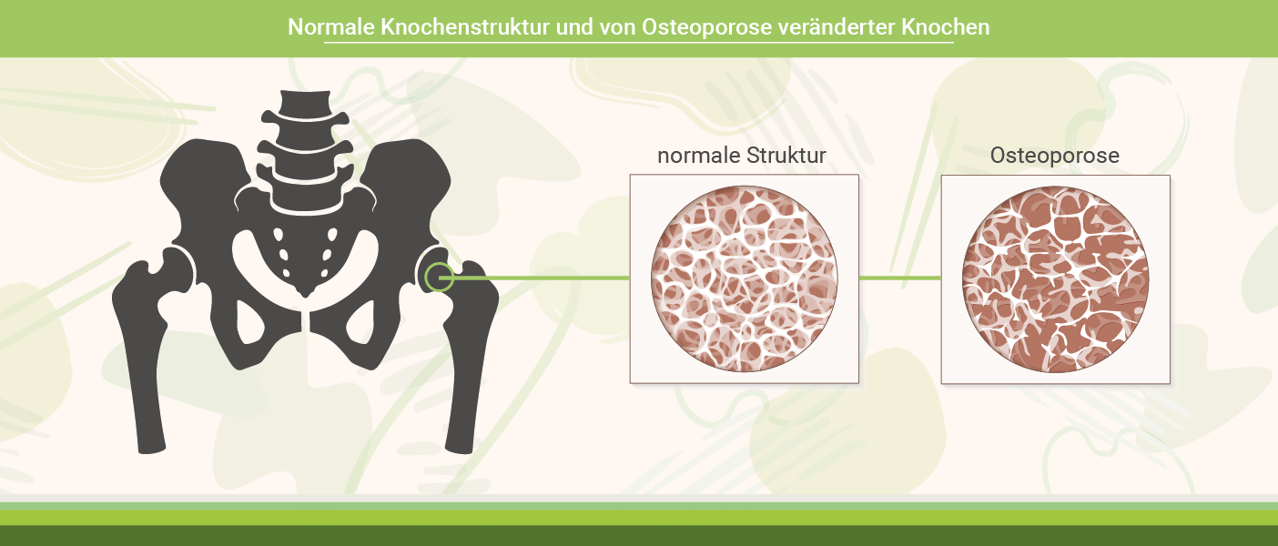 Infografik: Normale Knochenstruktur VS. von Osteoporose veränderte Knochenstruktur